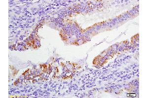 Formalin-fixed and paraffin embedded human colon carcinoma labeled with Anti-Phospho-FHIT (Tyr114) Polyclonal Antibody, Unconjugated (ABIN684808) at 1:200 followed by conjugation to the secondary antibody and DAB staining (FHIT antibody  (pTyr114))
