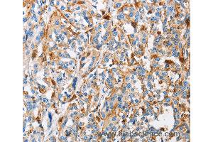 Immunohistochemistry of Human thyroid cancer using CTSL Polyclonal Antibody at dilution of 1:50