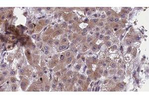 ABIN6277419 at 1/100 staining Human liver cancer tissue by IHC-P. (P2RY11 antibody)