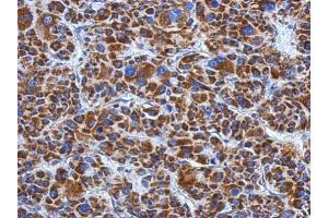 IHC-P Image Immunohistochemical analysis of paraffin-embedded human hepatoma, using DLD, antibody at 1:500 dilution.