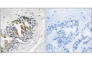 Immunohistochemistry analysis of paraffin-embedded human prostate carcinoma tissue, using RPLP2 Antibody. (RPLP2 antibody  (AA 21-70))