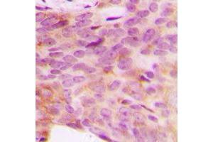 Immunohistochemical analysis of NDUFV3 staining in human breast cancer formalin fixed paraffin embedded tissue section. (NDUFV3 antibody  (Center))