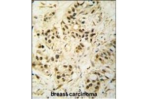 Formalin-fixed and paraffin-embedded human breast carcinoma tissue reacted with CDK1 Antibody (T14) (ABIN391744 and ABIN2841621) , which was peroxidase-conjugated to the secondary antibody, followed by DAB staining. (CDK1 antibody  (AA 1-30))