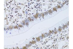 Immunohistochemistry of paraffin-embedded human gastric cancer using LMNB2 Antibody (ABIN5973877) at dilution of 1/100 (40x lens). (Lamin B2 antibody)