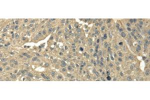 Immunohistochemistry of paraffin-embedded Human breast cancer using TRIB2 Polyclonal Antibody at dilution of 1/30 (TRIB2 antibody)