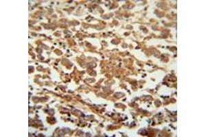 Immunohistochemistry analysis inhuman testis carcinoma (Formalin-fixed, Paraffin-embedded) using Speriolin / SPATC1 Antibody  (N-term), followed by peroxidase conjugation of the secondary antibody and DAB staining. (SPATC1 antibody  (N-Term))