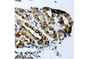 Immunohistochemical analysis of KCNN3 staining in human gastric cancer formalin fixed paraffin embedded tissue section. (KCNN3 antibody)