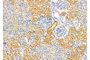 ABIN6259864 and ABIN6276627 at 1/100 staining Human kidney cancer and adjacent normal tissues by IHC-P. (AKR7A2 antibody  (Internal Region))