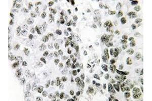 Immunohistochemistry analysis of SNAI1 antibody in paraffin-embedded Human lung carcinoma tissue. (SNAIL antibody)