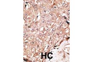 Formalin-fixed and paraffin-embedded human cancer tissue reacted with the primary antibody, which was peroxidase-conjugated to the secondary antibody, followed by DAB staining. (LSD1 antibody  (C-Term))