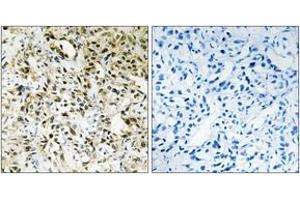 Immunohistochemistry analysis of paraffin-embedded human liver carcinoma tissue, using PPHLN Antibody. (PPHLN1 antibody  (AA 71-120))