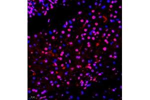 Immunofluorescence of paraffin embedded human liver cancer using smad62024 (ABIN7075629) at dilution of 1:1000 (400x lens) (SMAD6 antibody)