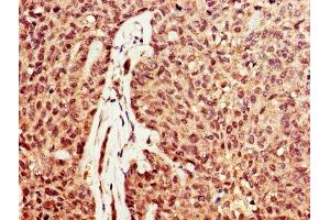 IHC image of ABIN7149726 diluted at 1:600 and staining in paraffin-embedded human ovarian cancer performed on a Leica BondTM system. (DNASE1 antibody  (AA 78-231))