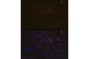 Immunofluorescence analysis of human breast cancer using PD-L1/CD274 Rabbit pAb (ABIN6129976, ABIN6138153, ABIN6138154 and ABIN6215142) at dilution of 1:100 (40x lens). (PD-L1 antibody  (AA 19-238))