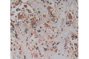 IHC-P analysis of breast cancer tissue, with DAB staining. (PRCP antibody  (AA 108-376))