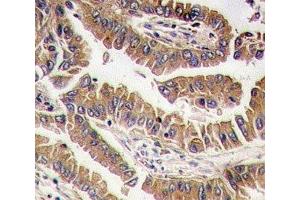 IHC analysis of FFPE human lung carcinoma tissue stained with BMP4 antibody (BMP4 antibody  (AA 5-34))