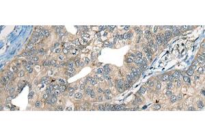 Immunohistochemistry of paraffin-embedded Human gastric cancer tissue using CDADC1 Polyclonal Antibody at dilution of 1:60(x200) (CDADC1 antibody)
