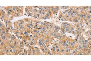 Immunohistochemistry of paraffin-embedded Human liver cancer tissue using ARMCX1 Polyclonal Antibody at dilution 1:40 (ARMCX1 antibody)