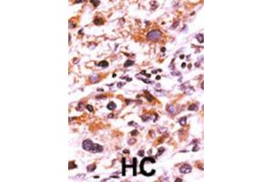Immunohistochemistry (IHC) image for anti-FGFR (pTyr766) antibody (ABIN3001757) (FGFR (pTyr766) antibody)