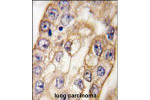 Formalin-fixed and paraffin-embedded human lung carcinoma tissue reacted with CD8A polyclonal antibody , which was peroxidase-conjugated to the secondary antibody, followed by DAB staining. (CD8 alpha antibody  (C-Term))