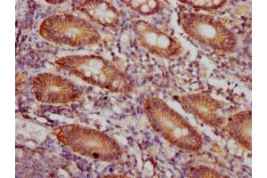 IHC image of ABIN7127403 diluted at 1:100 and staining in paraffin-embedded human colon cancer performed on a Leica BondTM system. (Recombinant CD46 antibody)