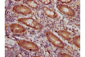 IHC image of ABIN7127403 diluted at 1:100 and staining in paraffin-embedded human colon cancer performed on a Leica BondTM system.