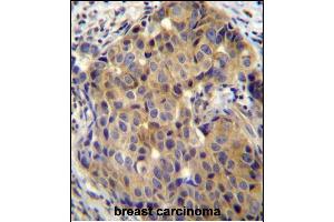 ST14 Antibody (C-term) (ABIN652185 and ABIN2840675) immunohistochemistry analysis in formalin fixed and paraffin embedded human breast carcinoma followed by peroxidase conjugation of the secondary antibody and DAB staining. (ST14 antibody  (C-Term))