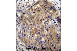 ST14 Antibody (C-term) (ABIN652185 and ABIN2840675) immunohistochemistry analysis in formalin fixed and paraffin embedded human breast carcinoma followed by peroxidase conjugation of the secondary antibody and DAB staining.