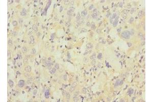 Immunohistochemistry of paraffin-embedded human liver cancer using ABIN7172186 at dilution of 1:100 (TRHDE antibody  (AA 62-200))