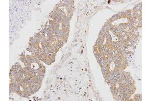 IHC-P Image Immunohistochemical analysis of paraffin-embedded OVCA xenograft, using MSTO1, antibody at 1:100 dilution. (MSTO1 antibody  (Center))