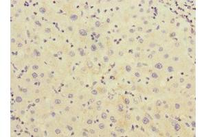 Immunohistochemistry of paraffin-embedded human liver cancer using ABIN7142967 at dilution of 1:100 (CHRNE antibody  (AA 21-239))