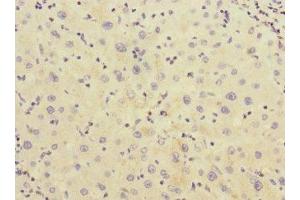 Immunohistochemistry of paraffin-embedded human liver cancer using ABIN7142967 at dilution of 1:100 (CHRNE antibody  (AA 21-239))