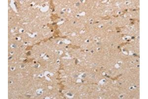 The image on the left is immunohistochemistry of paraffin-embedded Human brain tissue using ABIN7191581(NCAN Antibody) at dilution 1/30, on the right is treated with synthetic peptide. (Neurocan antibody)