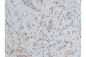 ABIN6268776 at 1/200 staining human breast cancer tissue sections by IHC-P. (MMP 9 antibody  (C-Term))