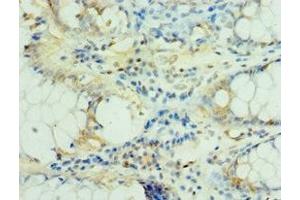 Immunohistochemistry of paraffin-embedded human colon cancer using ABIN7159382 at dilution of 1:100 (MS4A12 antibody  (AA 1-90))