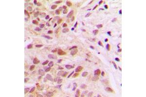 Immunohistochemical analysis of Rpb1 CTD (pSer5) staining in human breast cancer formalin fixed paraffin embedded tissue section. (Rpb1 CTD antibody  (C-Term, pSer5))