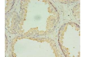 Immunohistochemistry of paraffin-embedded human prostate cancer using ABIN7150902 at dilution of 1:100