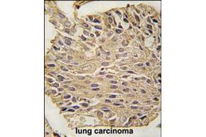 Formalin-fixed and paraffin-embedded human lung carcinoma tissue reacted with ALDOA antibody , which was peroxidase-conjugated to the secondary antibody, followed by DAB staining. (ALDOA antibody  (C-Term))