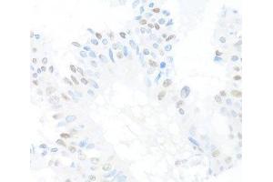 Immunohistochemistry of paraffin-embedded Human mammary cancer using CREM Polyclonal Antibody at dilution of 1:100 (40x lens). (CREM antibody)