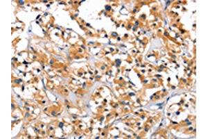 The image on the left is immunohistochemistry of paraffin-embedded Human thyroid cancer tissue using ABIN7128916(CEP97 Antibody) at dilution 1/40, on the right is treated with fusion protein.