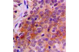 Immunohistochemical analysis of TXNRD2 staining in human breast cancer formalin fixed paraffin embedded tissue section. (TXNRD2 antibody  (C-Term))