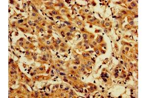 IHC image of ABIN7164696 diluted at 1:200 and staining in paraffin-embedded human liver cancer performed on a Leica BondTM system. (PDCD6 antibody  (AA 1-191))
