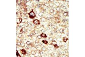 Formalin-fixed and paraffin-embedded human cancer tissue reacted with the primary antibody, which was peroxidase-conjugated to the secondary antibody, followed by AEC staining. (FGFR4 antibody  (N-Term))