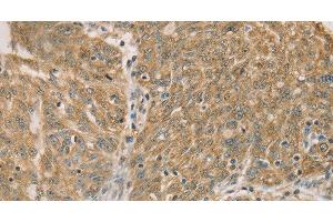 Immunohistochemistry of paraffin-embedded Human ovarian cancer using DMRT3 Polyclonal Antibody at dilution of 1:50 (DMRT3 antibody)