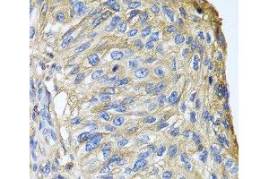 Immunohistochemistry of paraffin-embedded Human prostate cancer using APOA1 Polyclonal Antibody at dilution of 1:100 (40x lens). (APOA1 antibody)