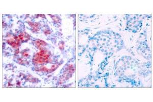 Immunohistochemical analysis of paraffin-embedded human breast carcinoma tissue using STAT4 (phospho-Tyr693) antibody (E011047). (STAT4 antibody  (pTyr693))
