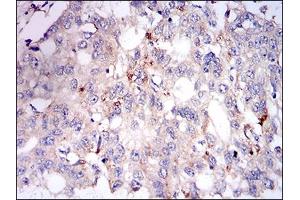 Immunohistochemical analysis of paraffin-embedded esophageal cancer tissues using PLIN2 mouse mAb with DAB staining. (ADRP antibody  (AA 286-437))