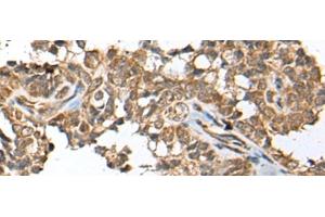Immunohistochemistry of paraffin-embedded Human ovarian cancer tissue using SPRTN Polyclonal Antibody at dilution of 1:65(x200)
