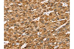 The image on the left is immunohistochemistry of paraffin-embedded Human liver cancer tissue using ABIN7192683(STK32B Antibody) at dilution 1/25, on the right is treated with synthetic peptide. (STK32B antibody)