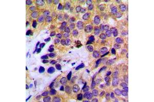 Immunohistochemical analysis of Cytokeratin 8 staining in human breast cancer formalin fixed paraffin embedded tissue section. (KRT8 antibody  (C-Term))